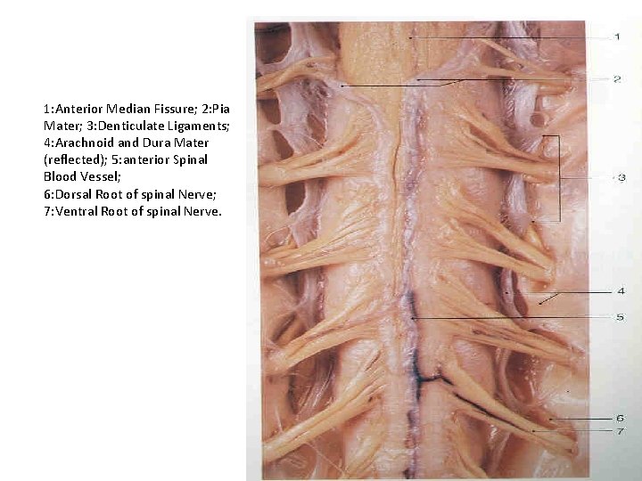 1: Anterior Median Fissure; 2: Pia Mater; 3: Denticulate Ligaments; 4: Arachnoid and Dura