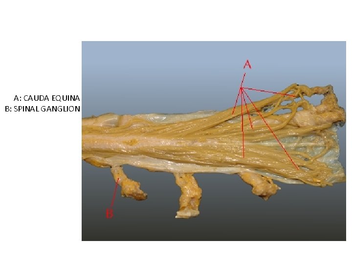 A: CAUDA EQUINA B: SPINAL GANGLION 