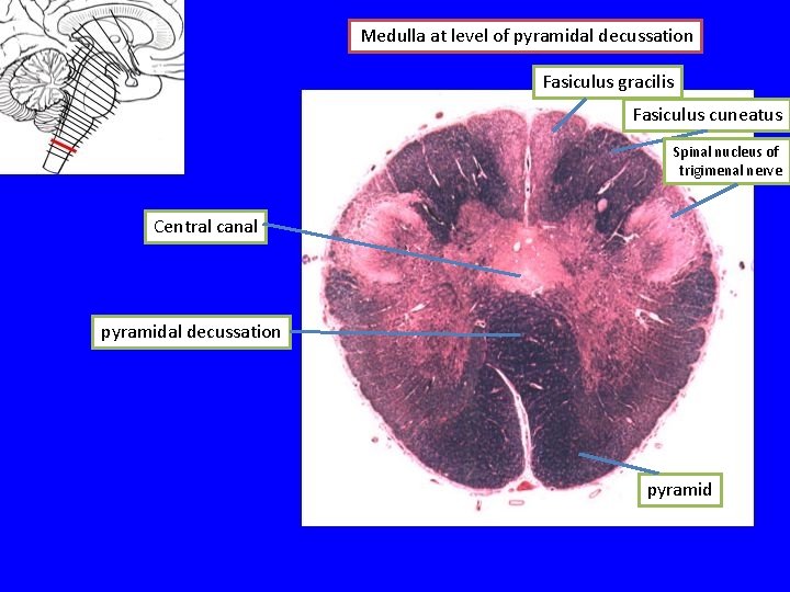 Medulla at level of pyramidal decussation Fasiculus gracilis Fasiculus cuneatus Spinal nucleus of trigimenal