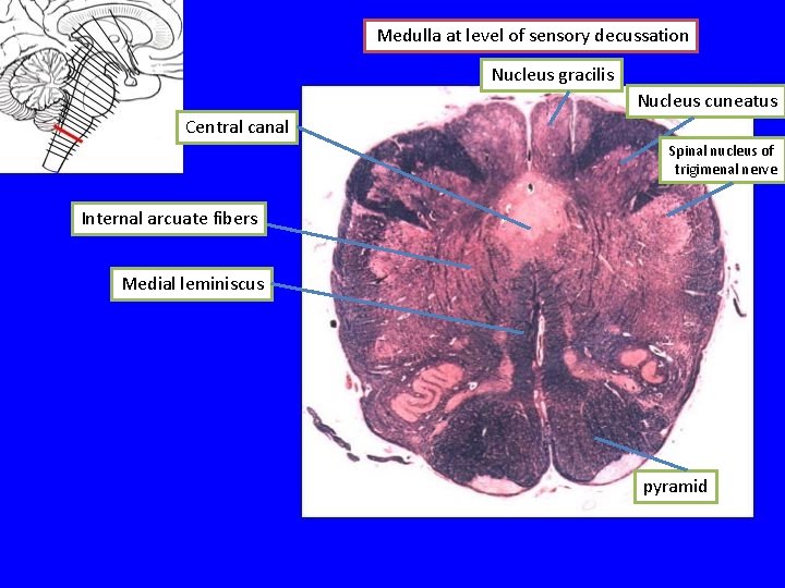 Medulla at level of sensory decussation Nucleus gracilis Nucleus cuneatus Central canal Spinal nucleus