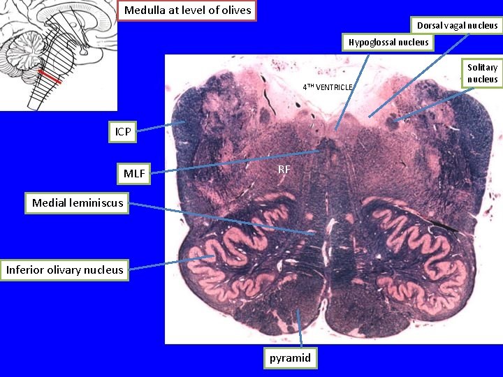 Medulla at level of olives Dorsal vagal nucleus Hypoglossal nucleus 4 TH VENTRICLE ICP