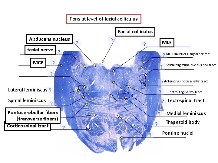 Pons at level of facial colliculus Facial colliculus Abducens nucleus facial nerve MCP MLF
