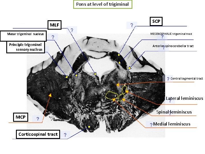 Pons at level of trigiminal MLF Motor trigeminal nucleus Principle trigeminal sensory nucleus SCP