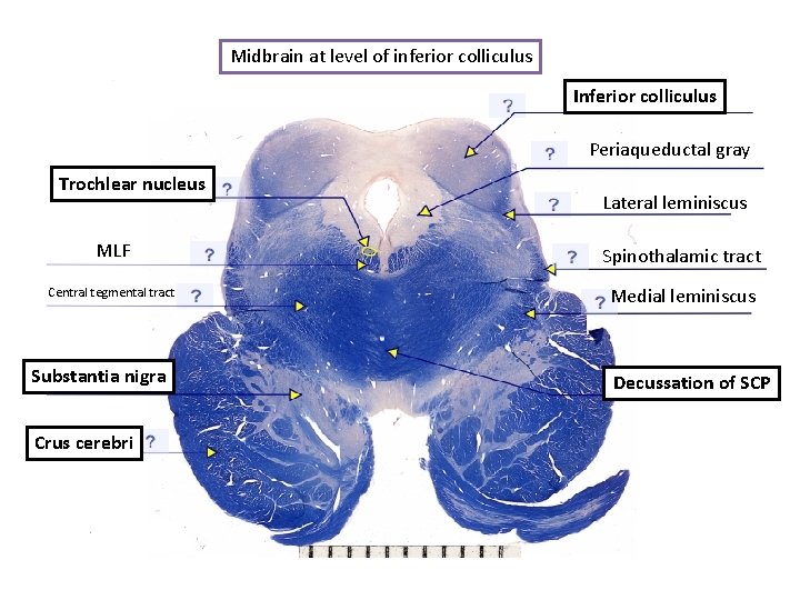 Midbrain at level of inferior colliculus Inferior colliculus Periaqueductal gray Trochlear nucleus Lateral leminiscus
