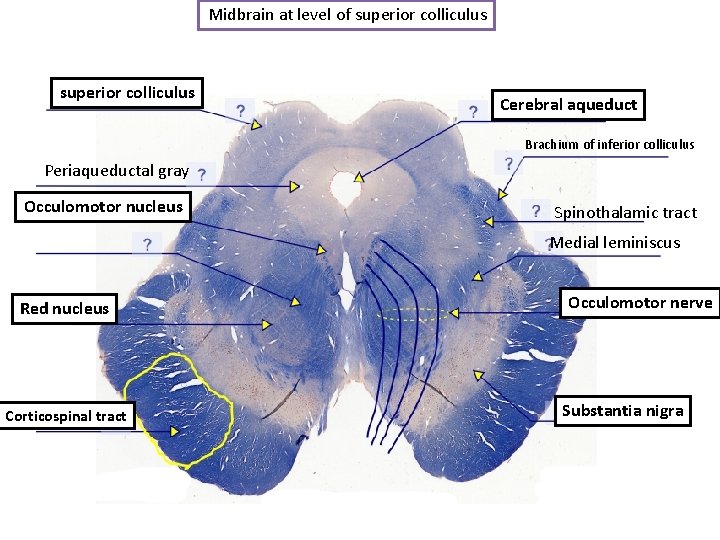 Midbrain at level of superior colliculus Cerebral aqueduct Brachium of inferior colliculus Periaqueductal gray