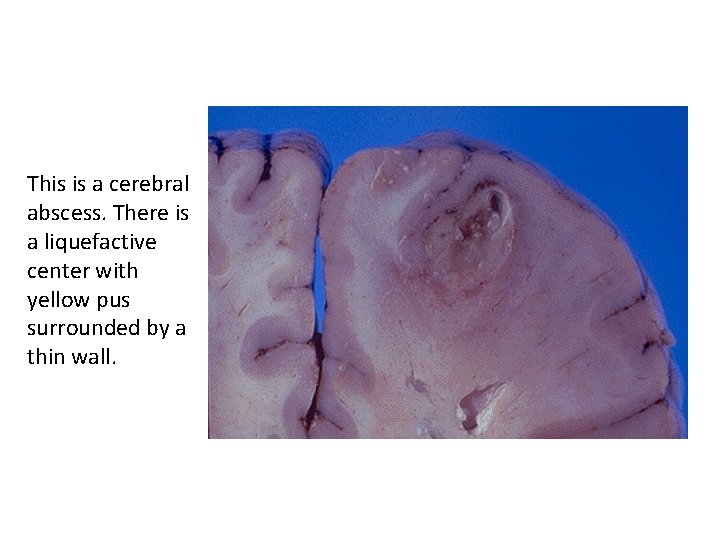 This is a cerebral abscess. There is a liquefactive center with yellow pus surrounded