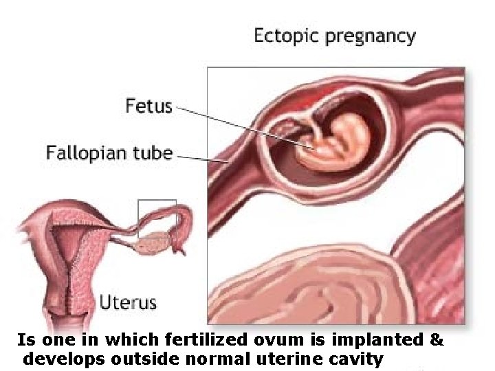 Is one in which fertilized ovum is implanted & develops outside normal uterine cavity