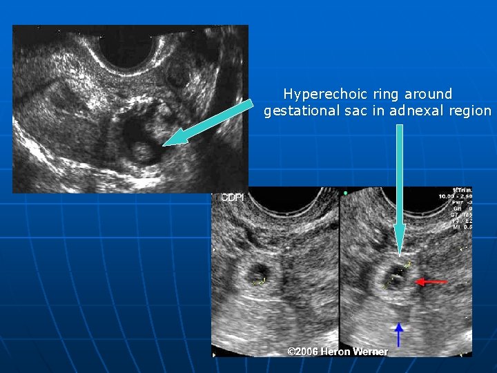 Hyperechoic ring around gestational sac in adnexal region 