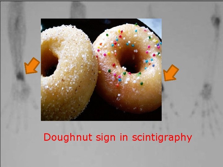 Doughnut sign in scintigraphy 