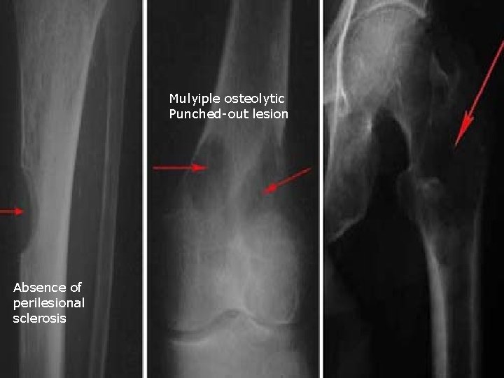Mulyiple osteolytic Punched-out lesion Absence of perilesional sclerosis 