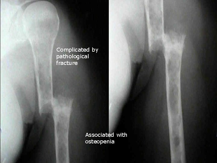 Complicated by pathological fracture Associated with osteopenia 