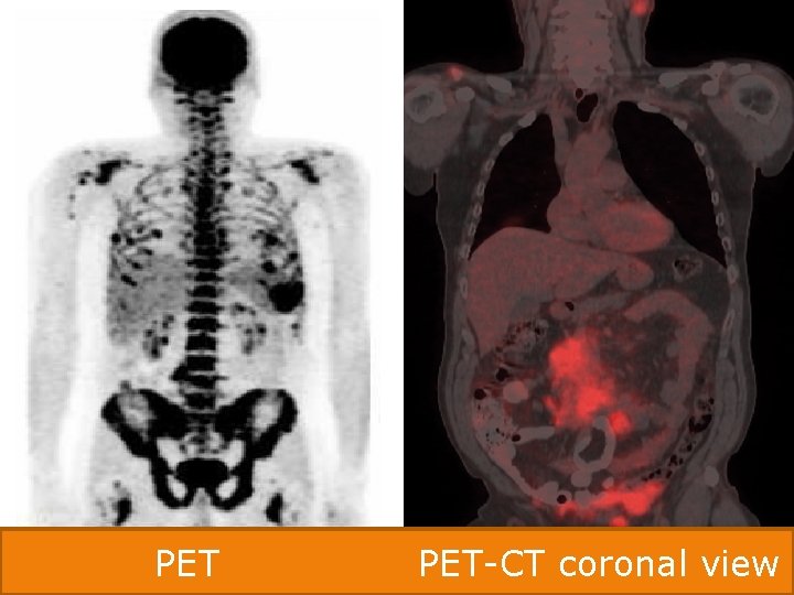 PET PET-CT coronal view 