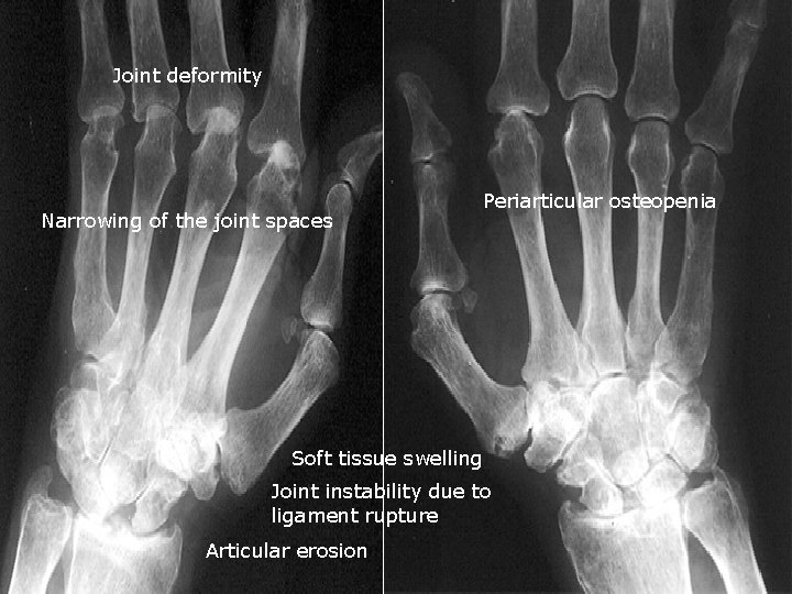 Joint deformity Narrowing of the joint spaces Periarticular osteopenia Soft tissue swelling Joint instability