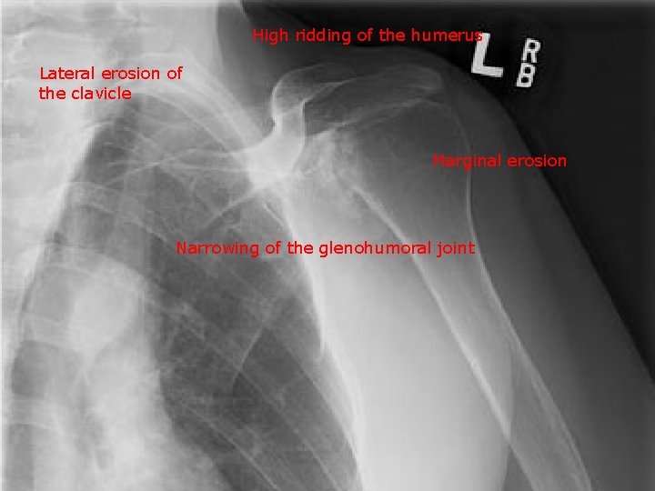 High ridding of the humerus Lateral erosion of the clavicle Marginal erosion Narrowing of