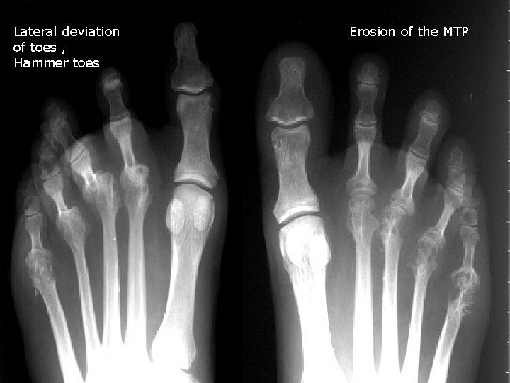 Lateral deviation of toes , Hammer toes Erosion of the MTP 