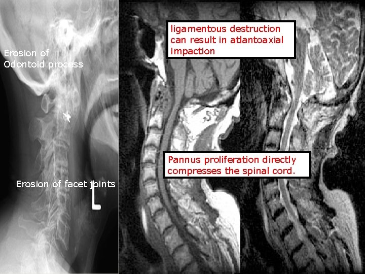 Erosion of Odontoid process ligamentous destruction can result in atlantoaxial impaction Pannus proliferation directly