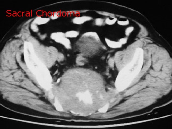Sacral Chordoma 