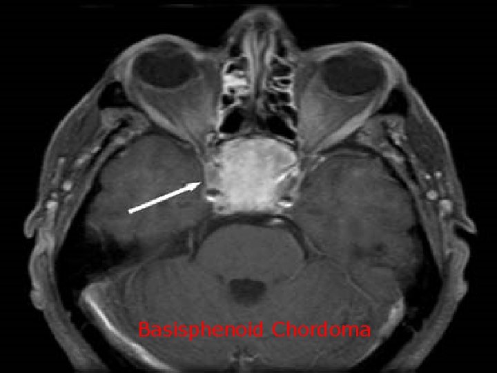 Basisphenoid Chordoma 