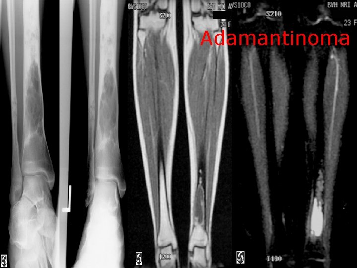 Adamantinoma 