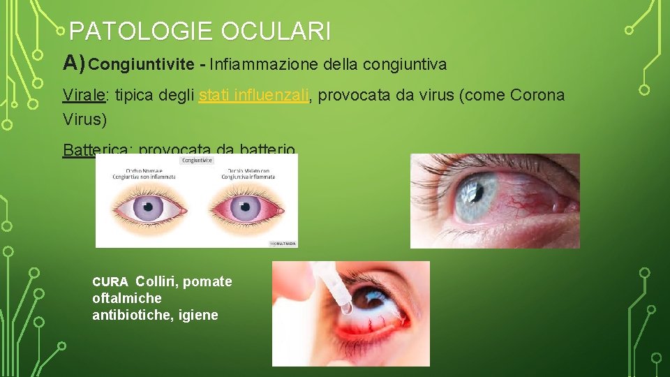 PATOLOGIE OCULARI A) Congiuntivite - Infiammazione della congiuntiva Virale: tipica degli stati influenzali, provocata