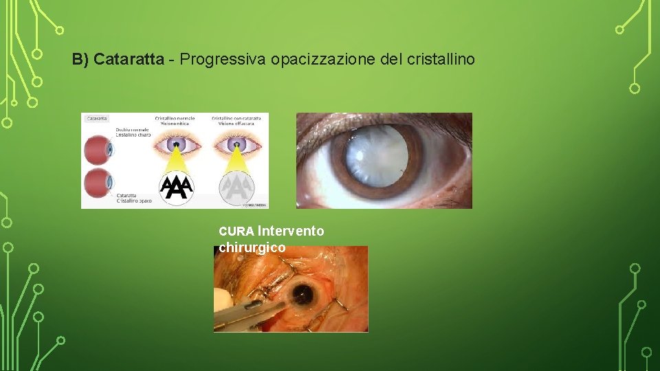 B) Cataratta - Progressiva opacizzazione del cristallino CURA Intervento chirurgico 