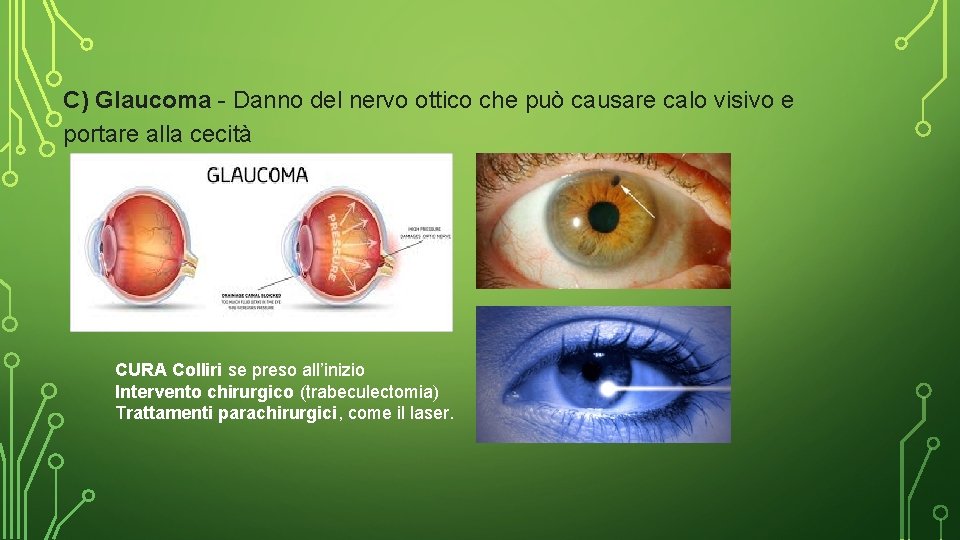 C) Glaucoma - Danno del nervo ottico che può causare calo visivo e portare