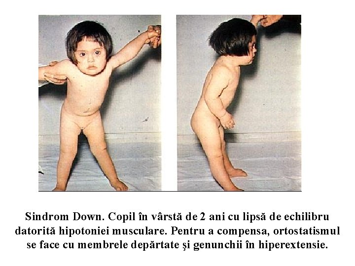 Sindrom Down. Copil în vârstă de 2 ani cu lipsă de echilibru datorită hipotoniei