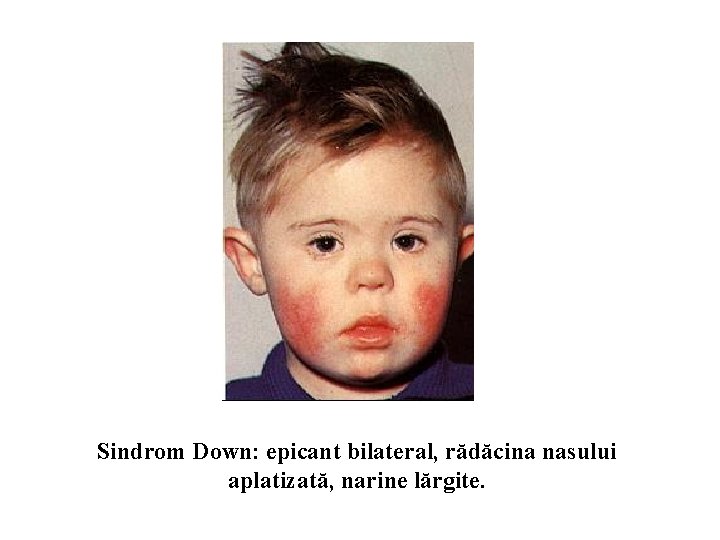 Sindrom Down: epicant bilateral, rădăcina nasului aplatizată, narine lărgite. 