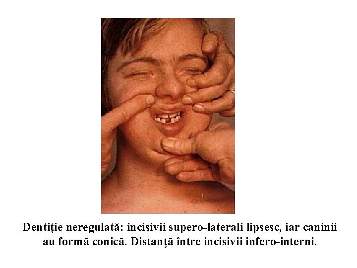 Dentiţie neregulată: incisivii supero-laterali lipsesc, iar caninii au formă conică. Distanţă între incisivii infero-interni.