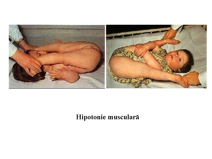 Hipotonie musculară 