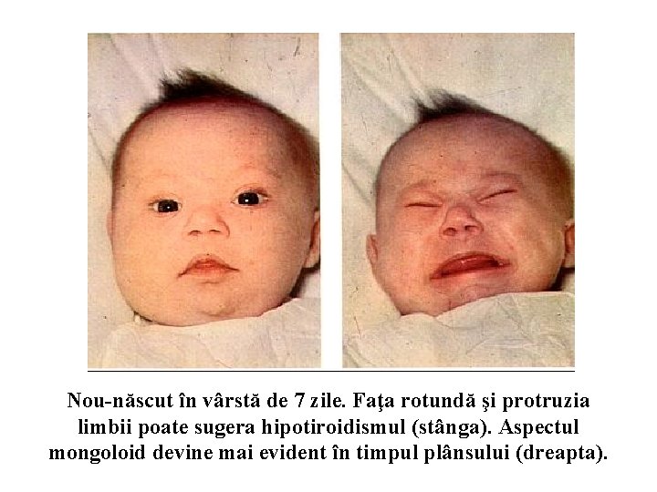 Nou-născut în vârstă de 7 zile. Faţa rotundă şi protruzia limbii poate sugera hipotiroidismul