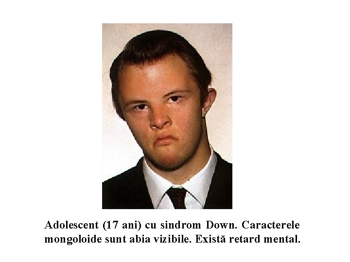 Adolescent (17 ani) cu sindrom Down. Caracterele mongoloide sunt abia vizibile. Există retard mental.