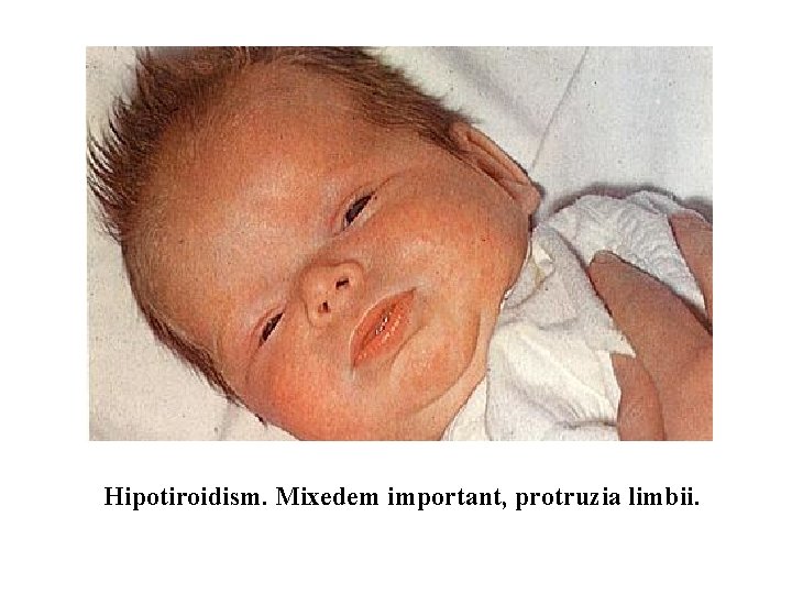 Hipotiroidism. Mixedem important, protruzia limbii. 