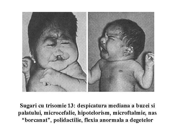 Sugari cu trisomie 13: despicatura mediana a buzei si palatului, microcefalie, hipotelorism, microftalmie, nas