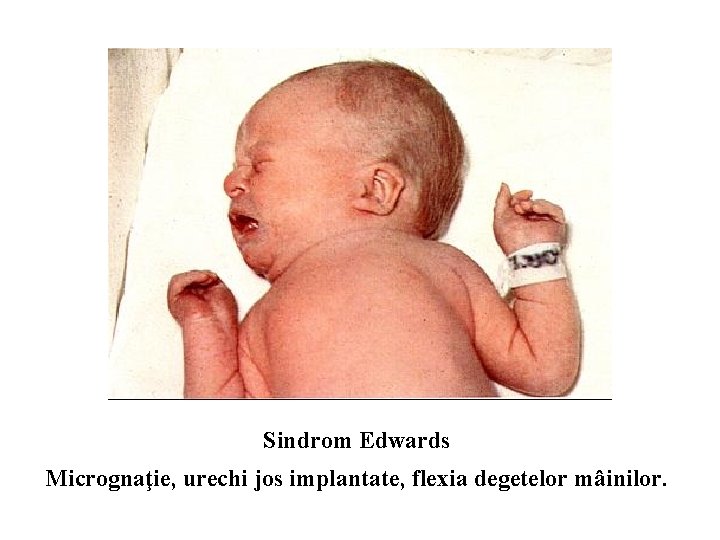 Sindrom Edwards Micrognaţie, urechi jos implantate, flexia degetelor mâinilor. 