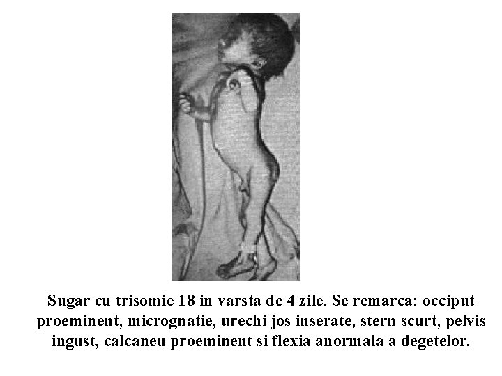 Sugar cu trisomie 18 in varsta de 4 zile. Se remarca: occiput proeminent, micrognatie,