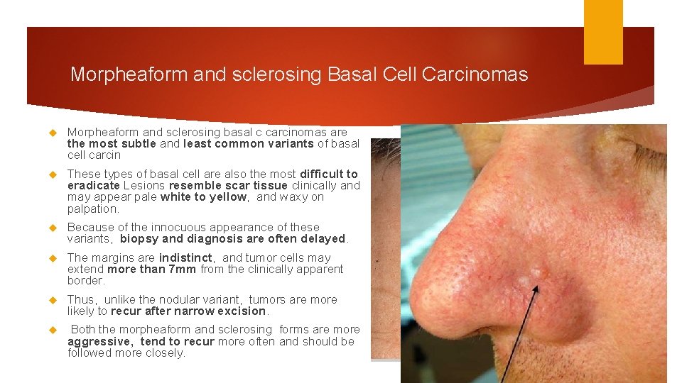 Morpheaform and sclerosing Basal Cell Carcinomas Morpheaform and sclerosing basal c carcinomas are the