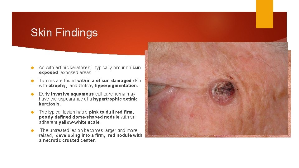 Skin Findings As with actinic keratoses, typically occur on sun exposed areas. Tumors are