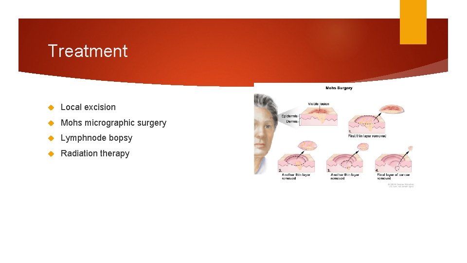 Treatment Local excision Mohs micrographic surgery Lymphnode bopsy Radiation therapy 