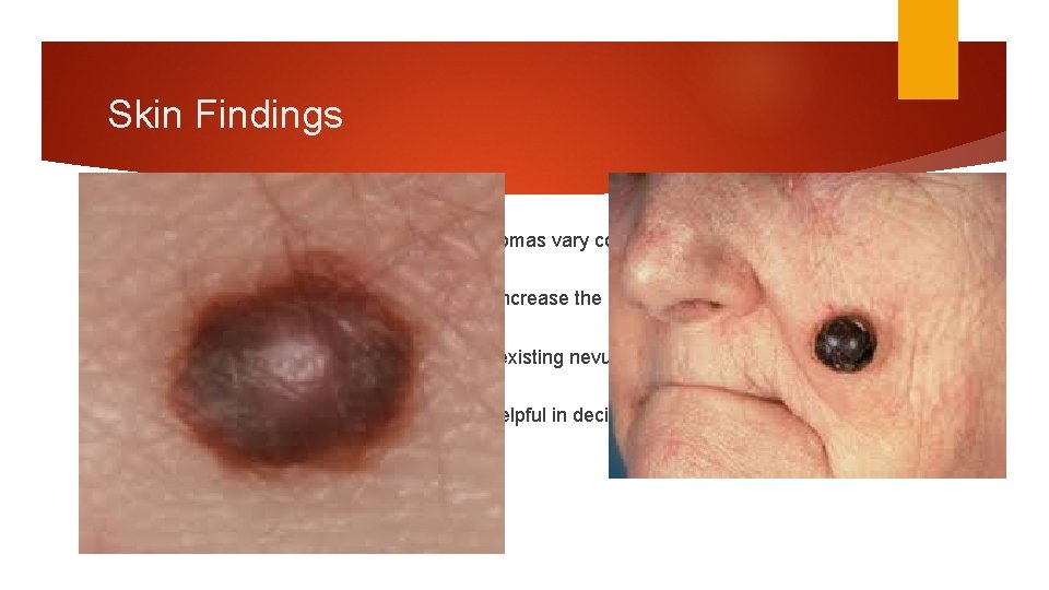 Skin Findings It cannot be over-emphasized that melanomas vary considerably in appearance single color