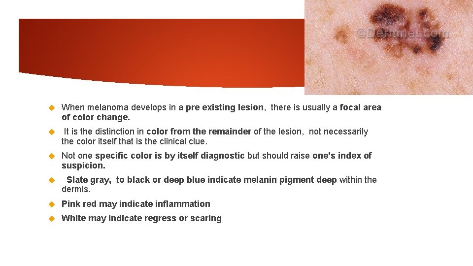  When melanoma develops in a pre existing lesion, there is usually a focal