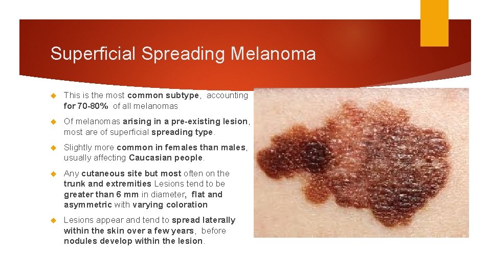 Superficial Spreading Melanoma This is the most common subtype, accounting for 70 -80% of