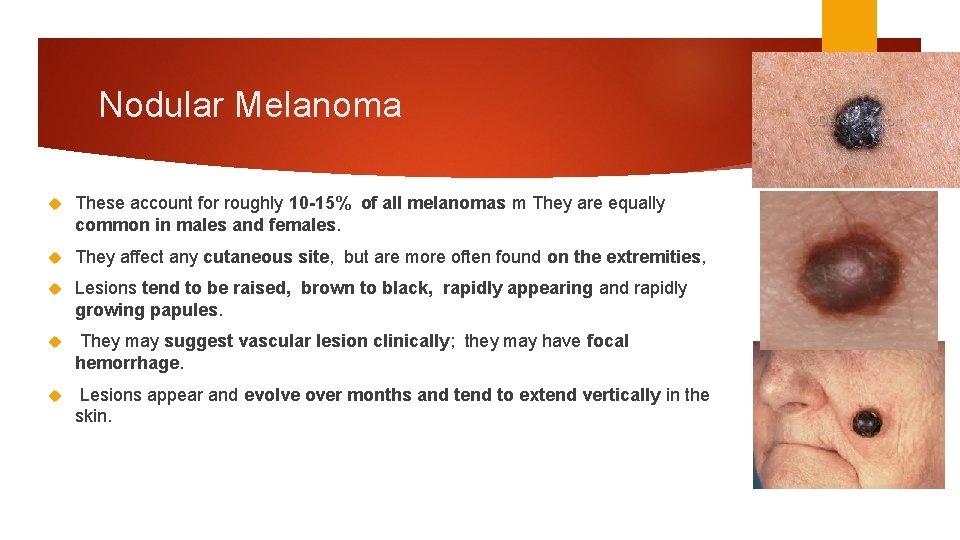 Nodular Melanoma These account for roughly 10 -15% of all melanomas m They are