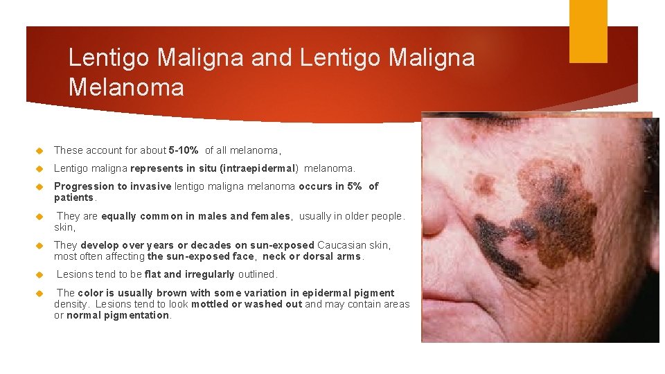 Lentigo Maligna and Lentigo Maligna Melanoma These account for about 5 -10% of all