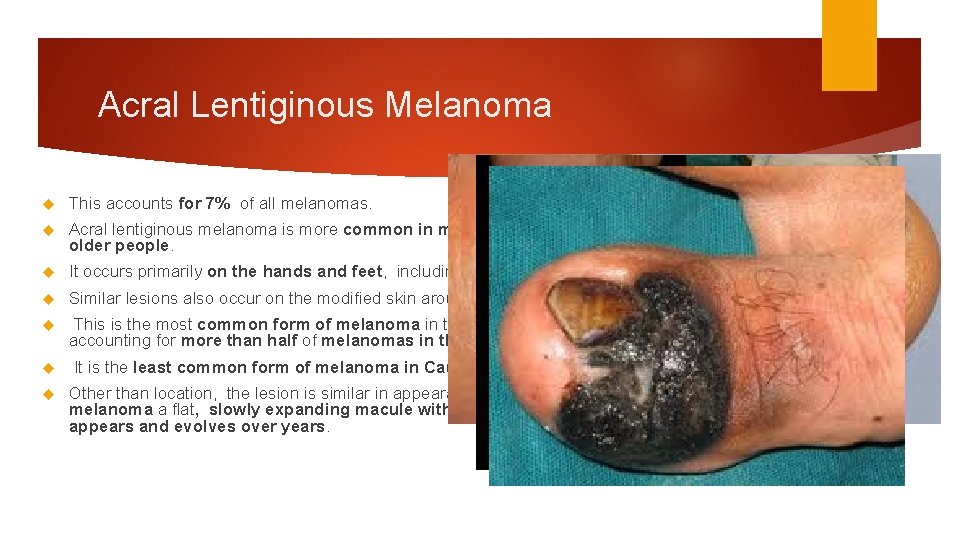 Acral Lentiginous Melanoma This accounts for 7% of all melanomas. Acral lentiginous melanoma is