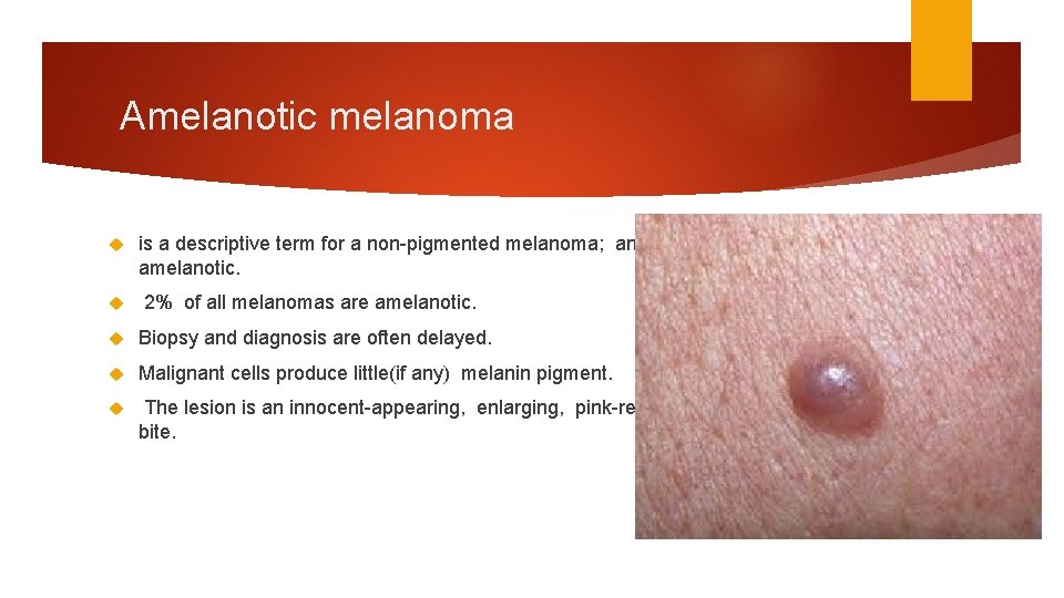 Amelanotic melanoma is a descriptive term for a non-pigmented melanoma; any subtype may be