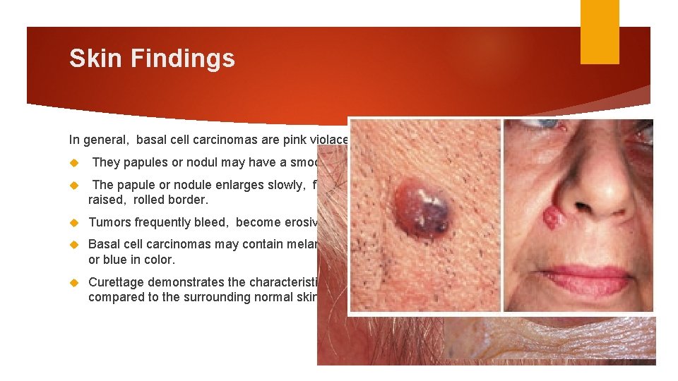 Skin Findings In general, basal cell carcinomas are pink violaceous or pearly sometimes They