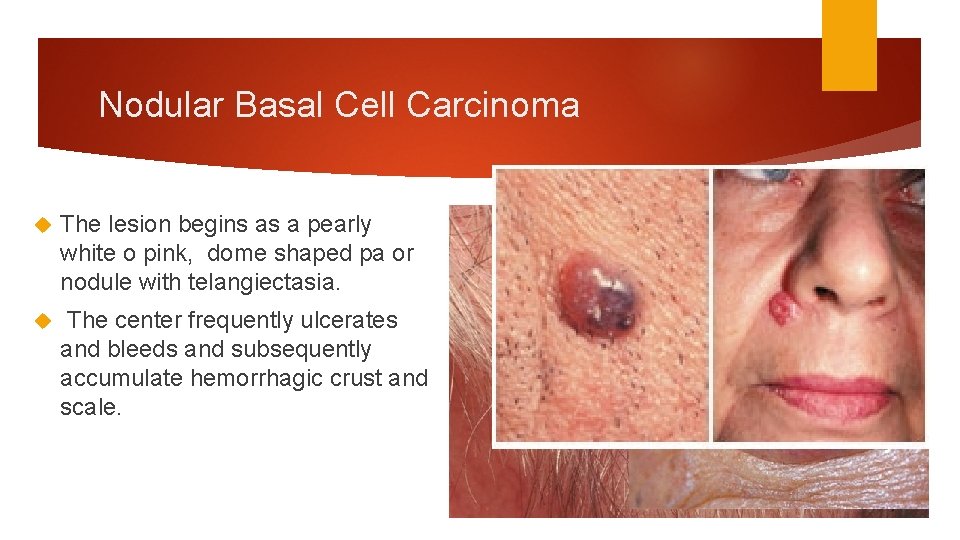 Nodular Basal Cell Carcinoma The lesion begins as a pearly white o pink, dome