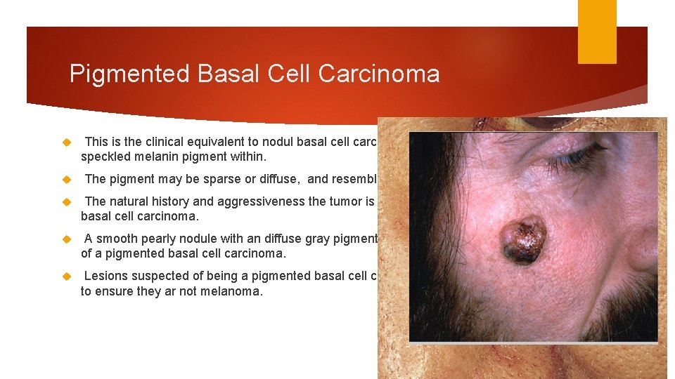 Pigmented Basal Cell Carcinoma This is the clinical equivalent to nodul basal cell carcinoma,