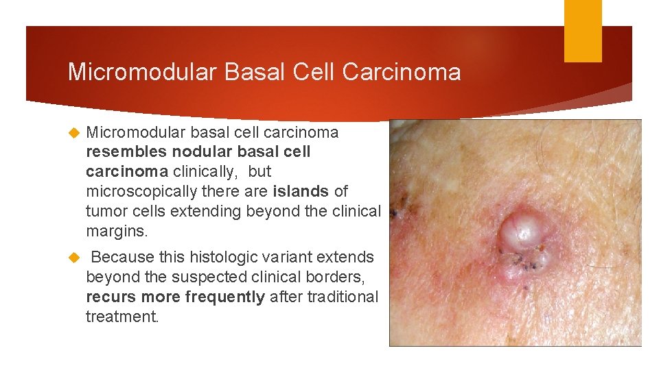Micromodular Basal Cell Carcinoma Micromodular basal cell carcinoma resembles nodular basal cell carcinoma clinically,